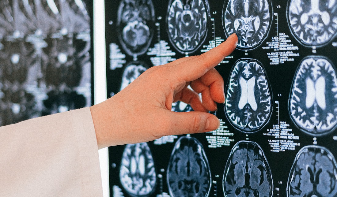 10 Ways to Beat Writer’s Block According to Science_brain scan